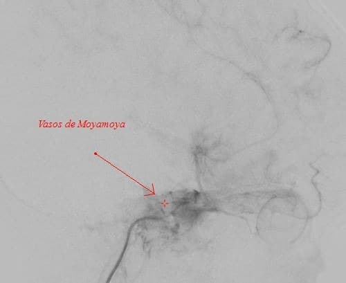Vasos De Moyamoya
