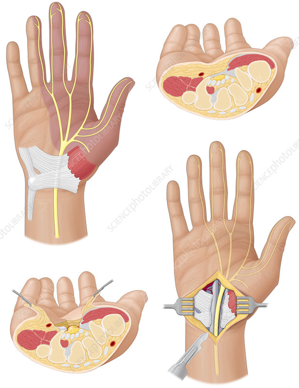 Carpal Tunnel Surgery