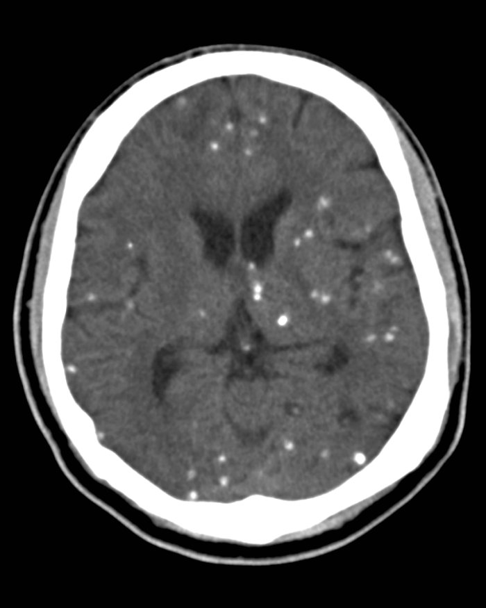 Neurocysticercosis 4