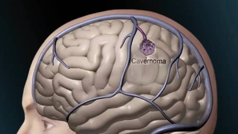 Cavernomas Cerebrais 1