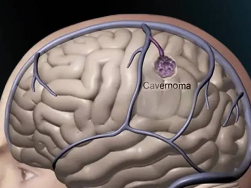 Cavernomas Cerebrais 1
