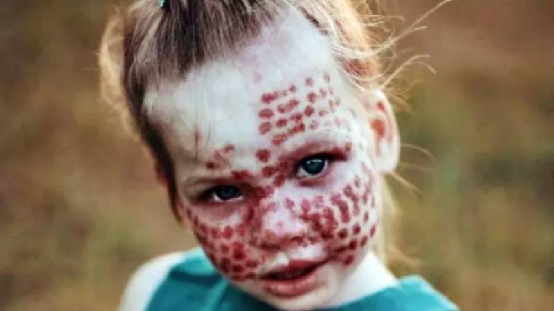 Sindrome De Sturge Weber